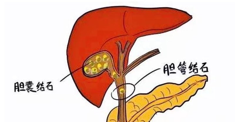 肝胆结石