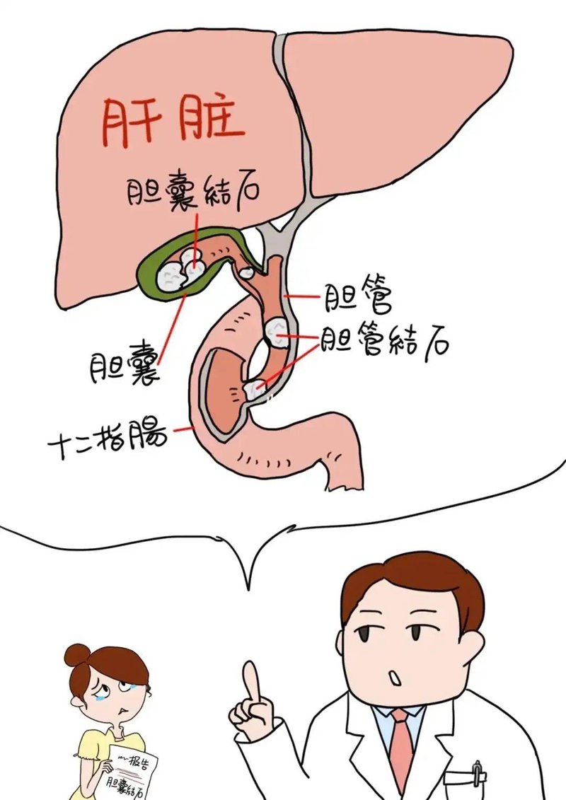 胆结石手术后安装与维护注意事项