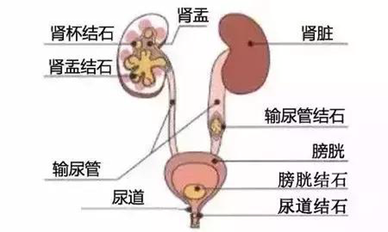 警惕保肾取石误区，科学应对肾脏健康