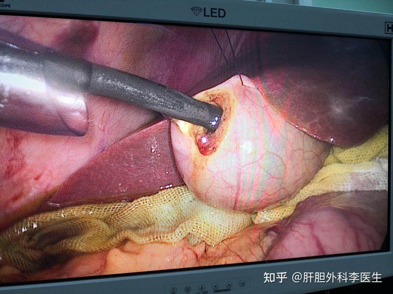 胆结石手术：常见问题解答