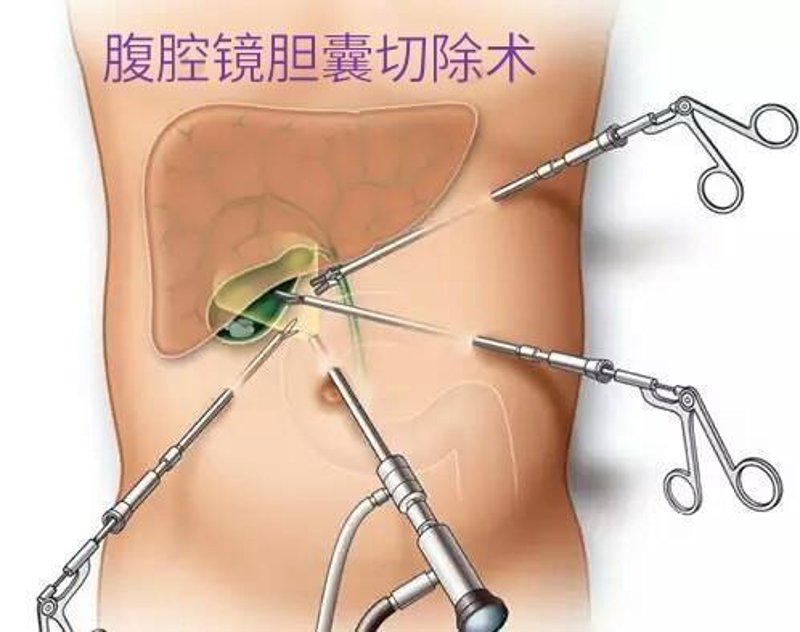 胆结石手术:常见的医疗选择与发展趋势