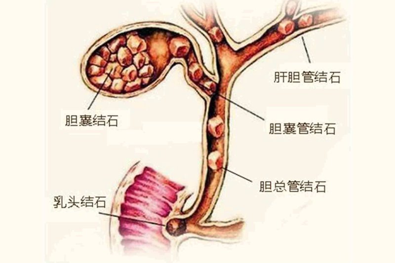 胆结石手术：趋势解读