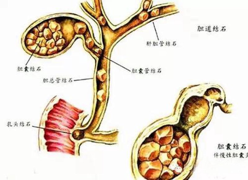 保肾取石案例分析：守护健康从细节做起