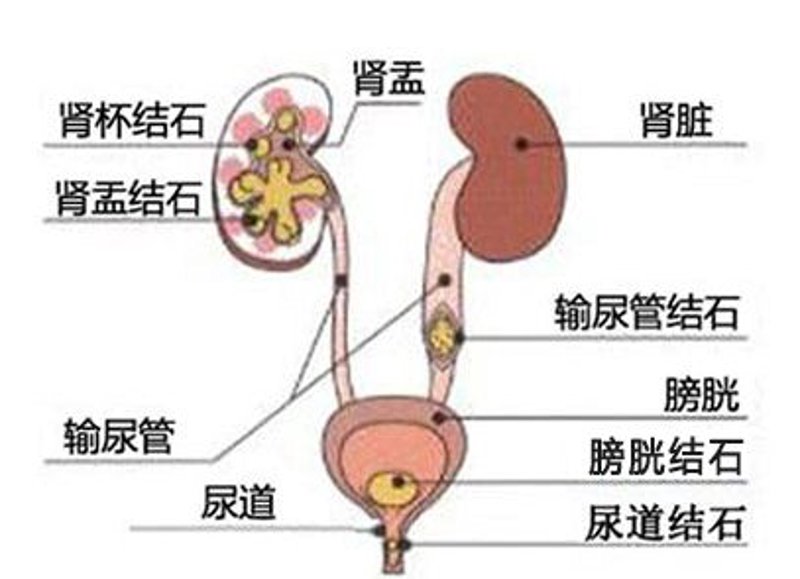 泌尿系结石