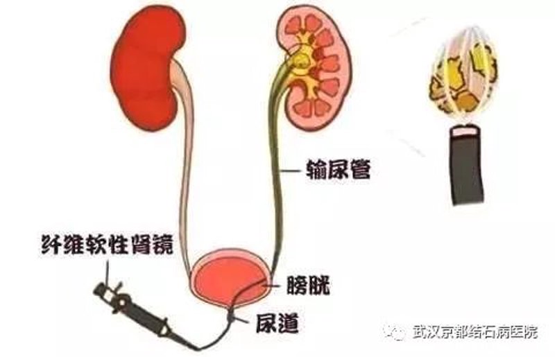 肾结石治疗误区警示：正确应对才能走出困境